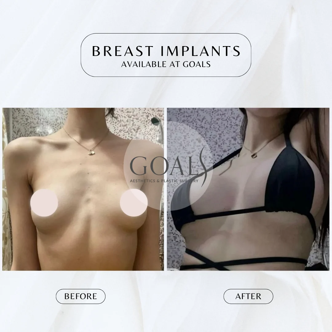 Before and after — Breast Augmentation · Gaithersburg, patient 6