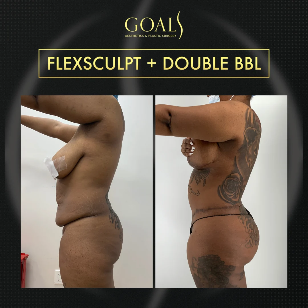 Brazilian Butt Lift — patient result