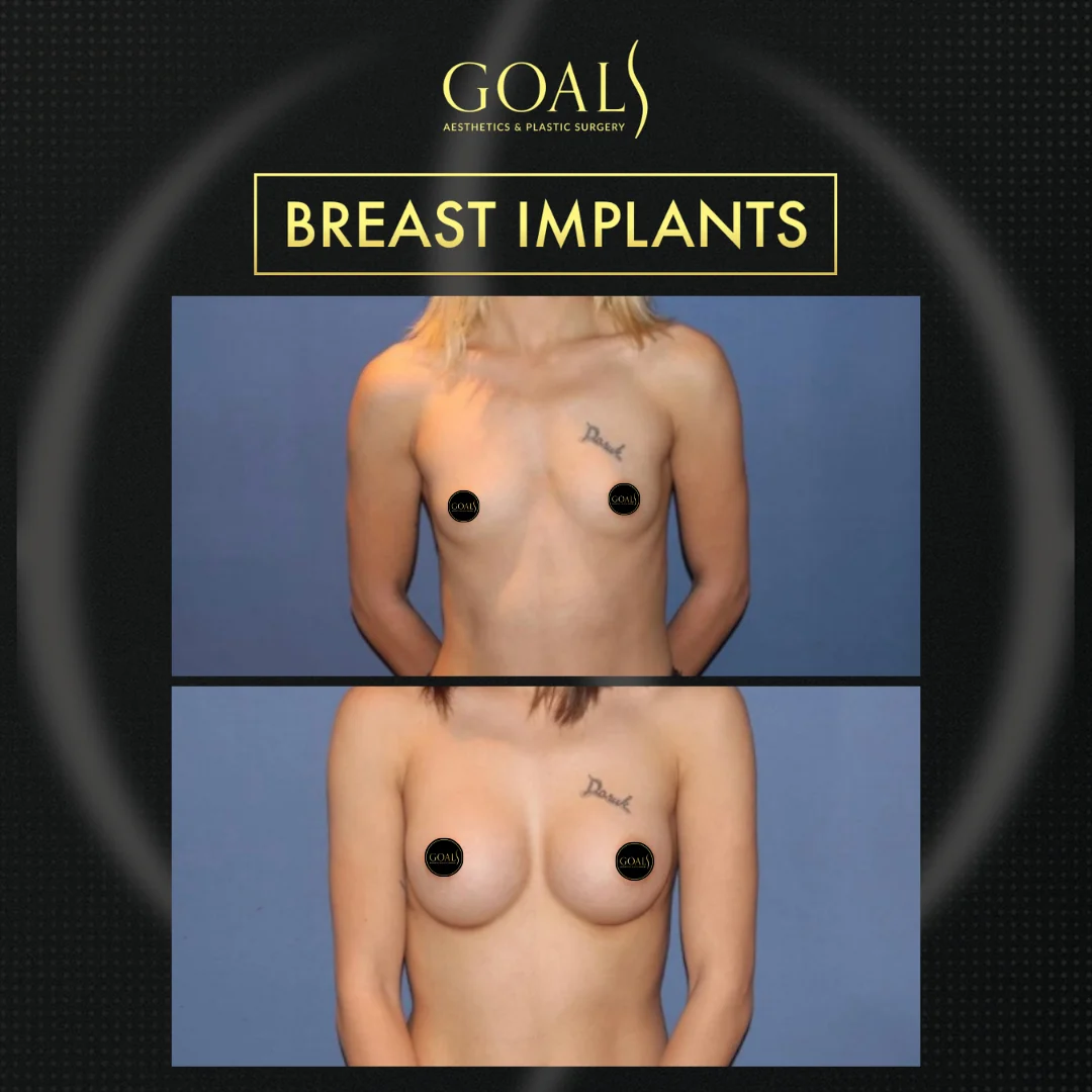 Breast Augmentation — patient result