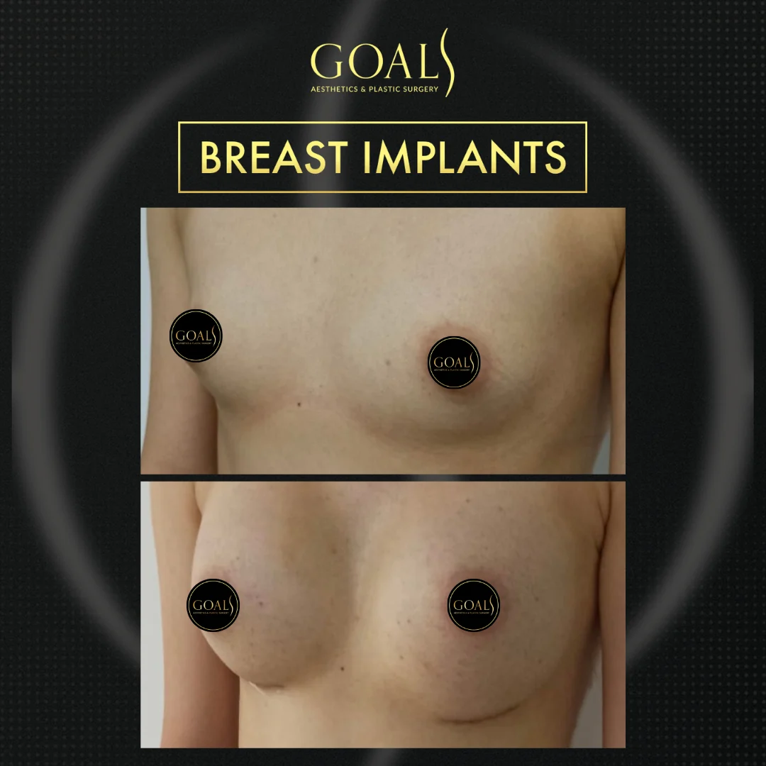 Before and after — Breast Augmentation · Philadelphia, patient 1