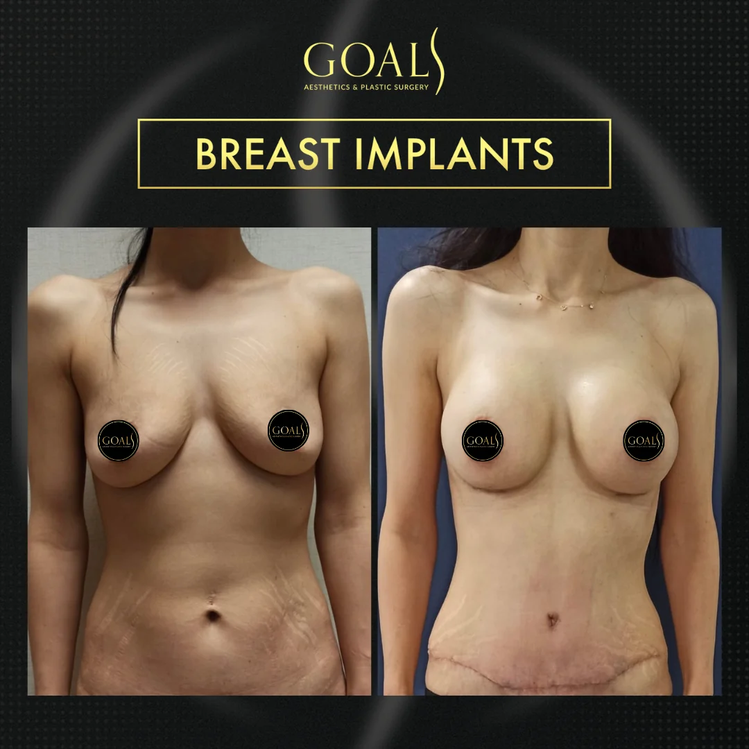 Before and after — Breast Augmentation · Philadelphia, patient 2