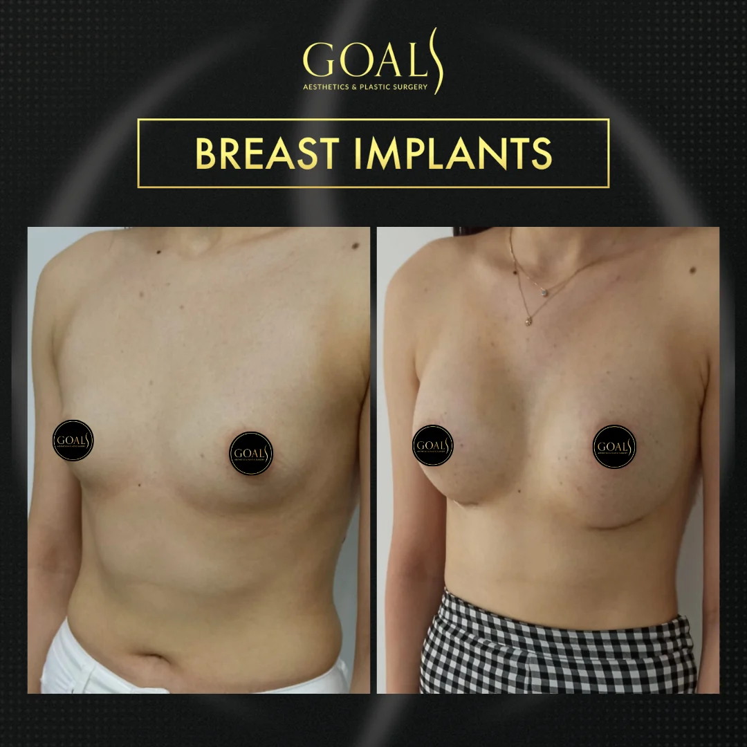 Before and after — Breast Augmentation · Philadelphia, patient 4