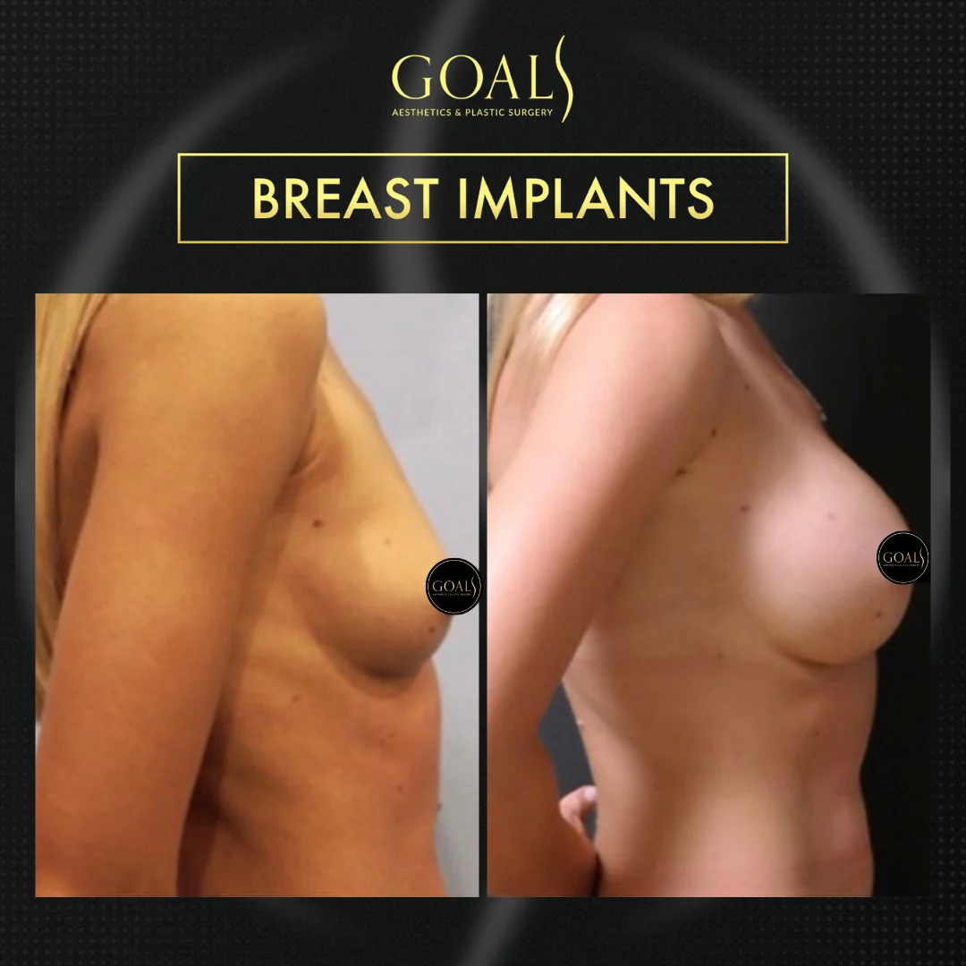 Before and after — Breast Augmentation · Philadelphia, patient 5