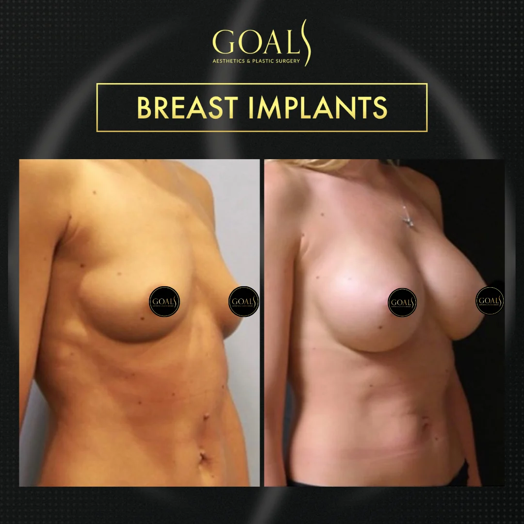 Before and after — Breast Augmentation · Philadelphia, patient 6