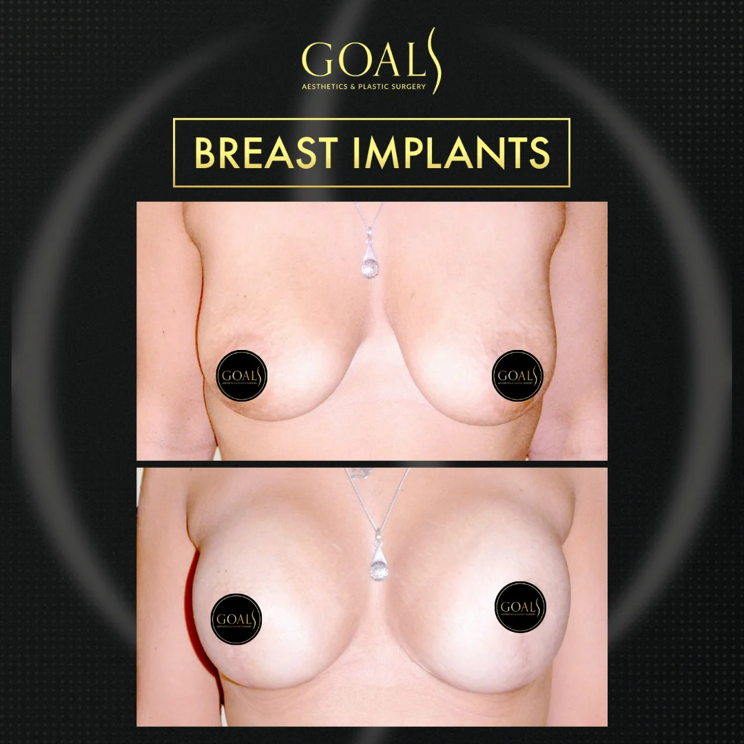 Before and after — Breast Augmentation, patient 1