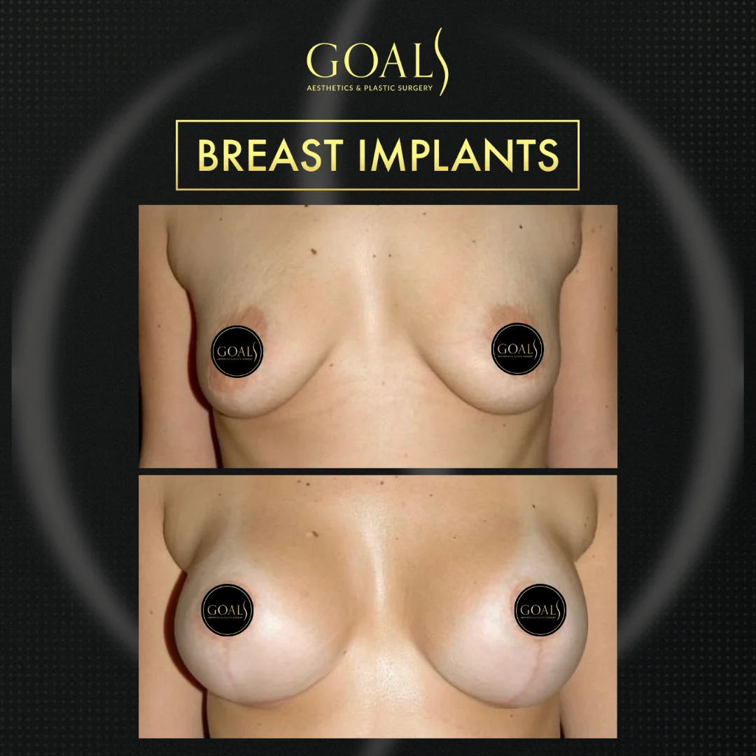 Before and after — Breast Augmentation, patient 2