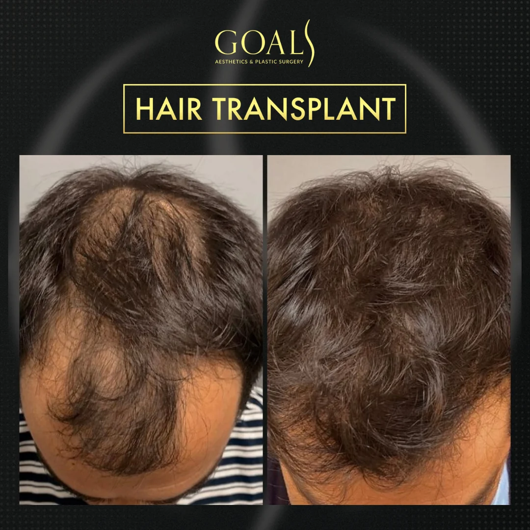 Before and after — Trasplante Capilar FUT, patient 6