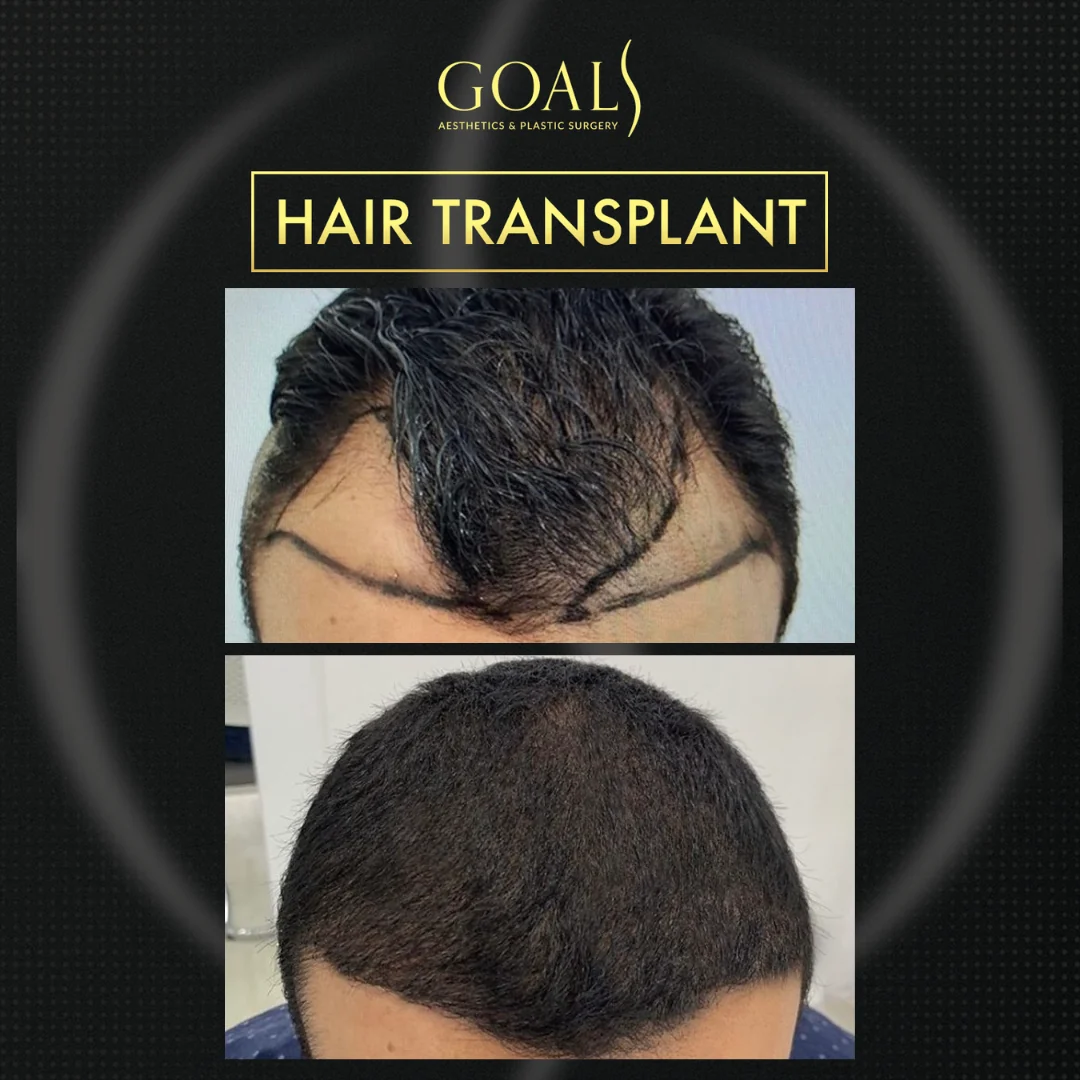 Before and after — FUT Hair Transplant · Atlanta Walton St., patient 4