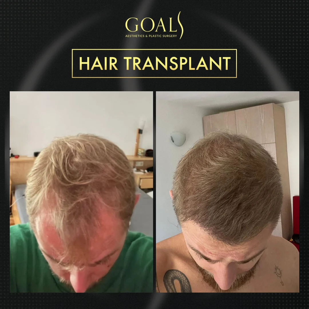 Before and after — FUT Hair Transplant · Atlanta Walton St., patient 5