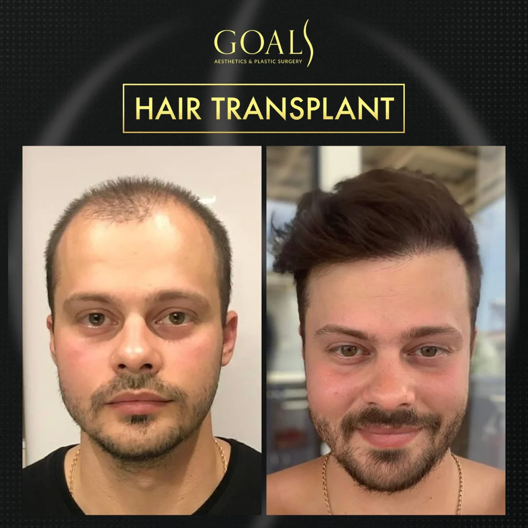 Before and after — Trasplante Capilar para Hombres, patient 1