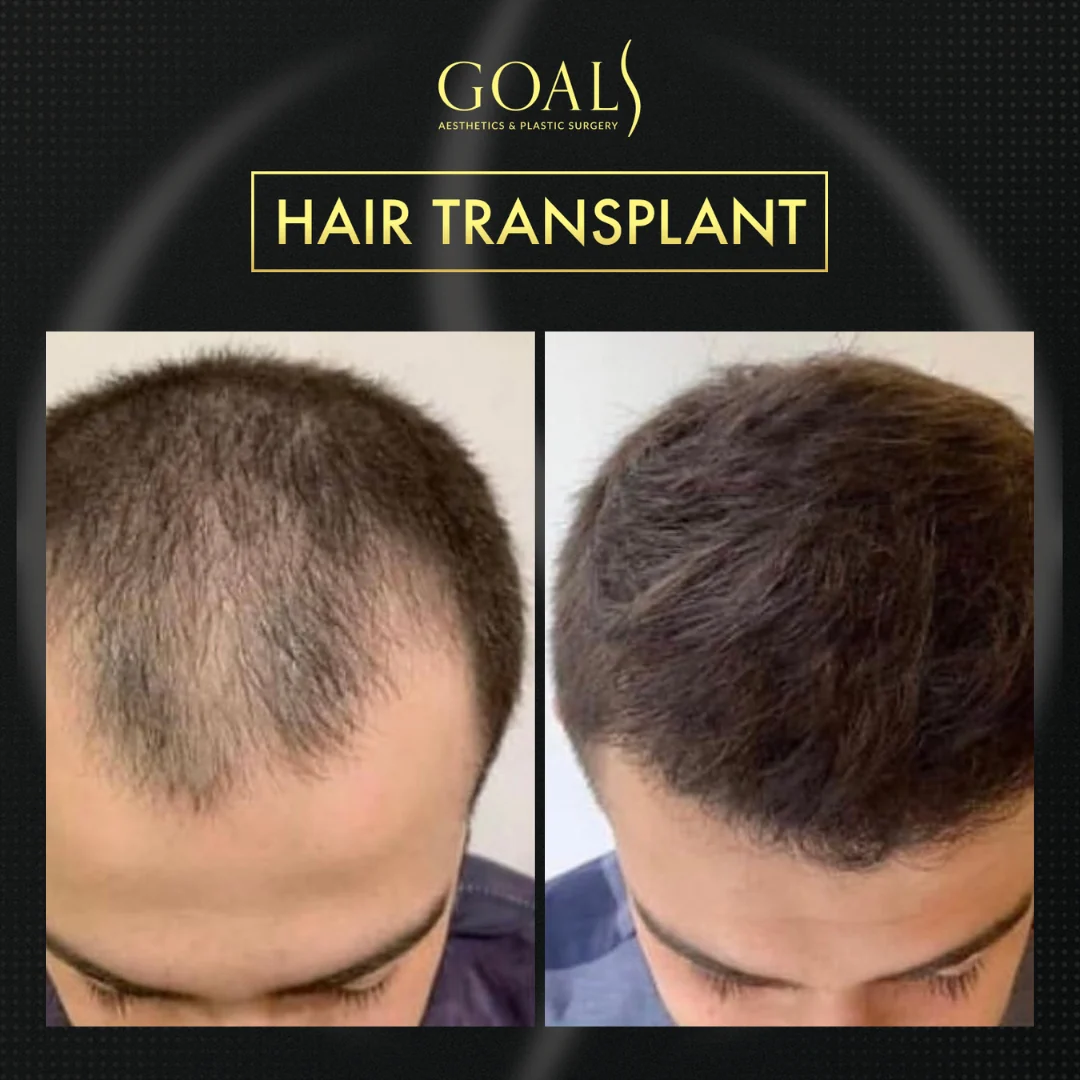 Before and after — Men's Hair Transplant · Central Park, patient 1