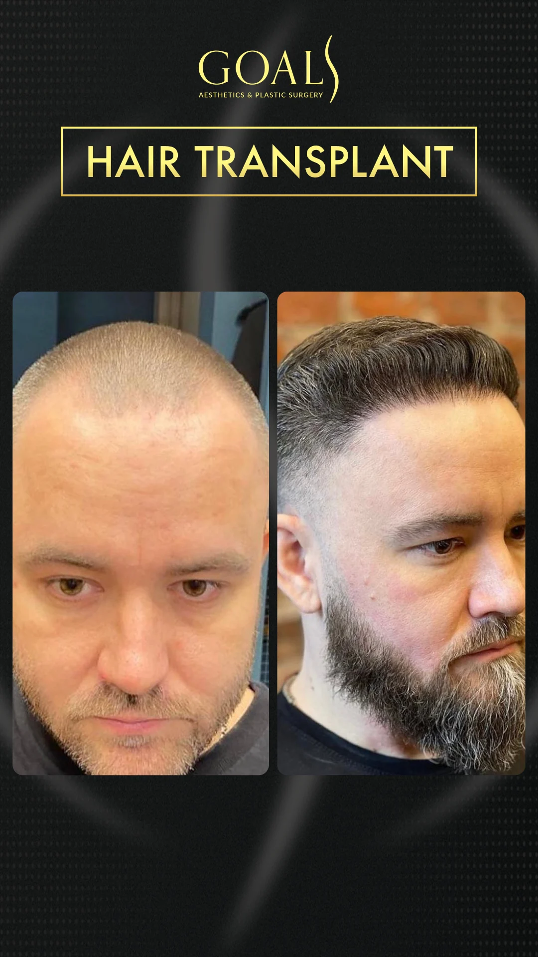 Before and after — Men's Hair Transplant · Central Park, patient 2