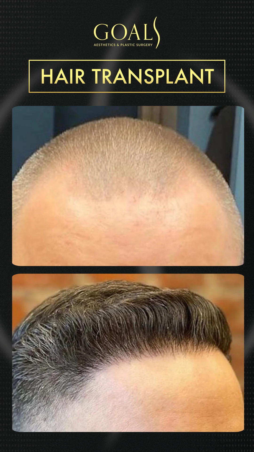 Before and after — Trasplante Capilar FUT, patient 1