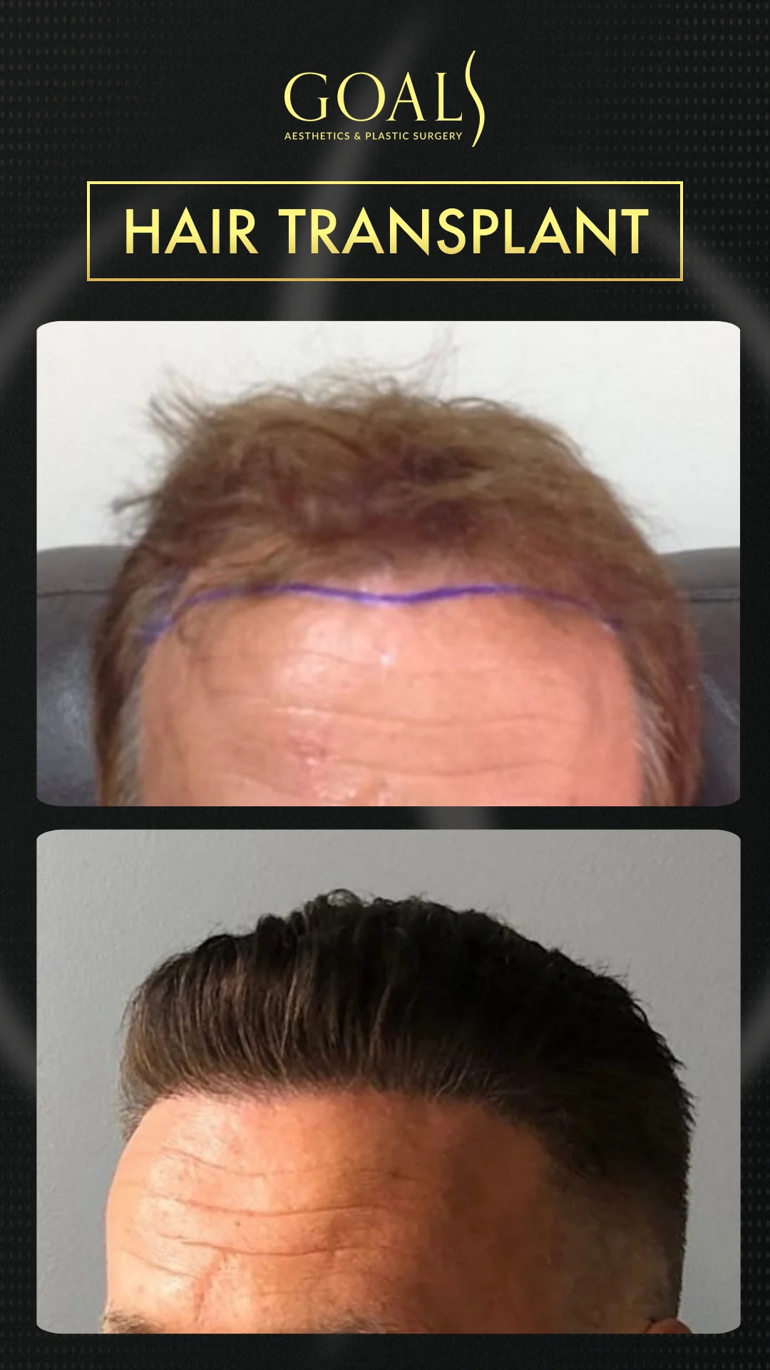 Before and after — Men's Hair Transplant · Central Park, patient 4