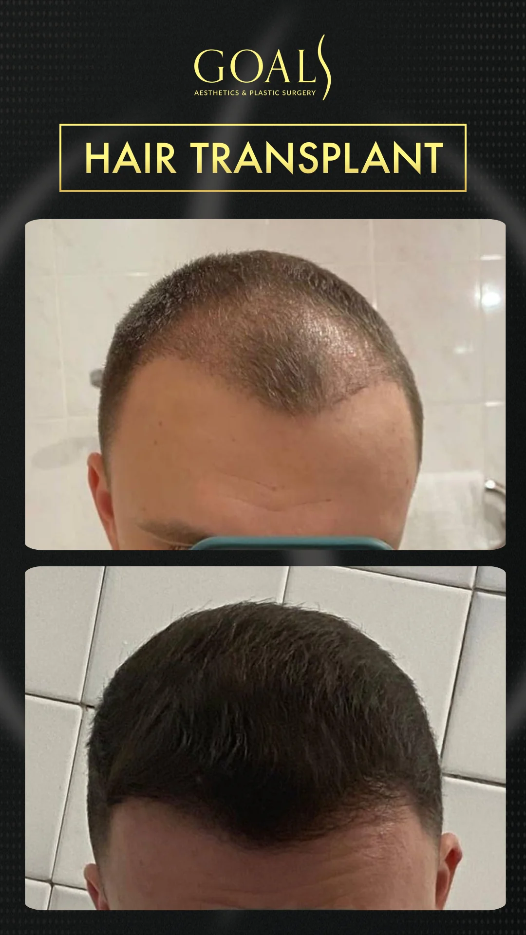 Before and after — Trasplante Capilar FUT, patient 2
