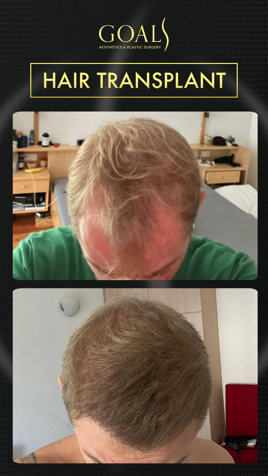 Before and after — Trasplante Capilar FUT, patient 3