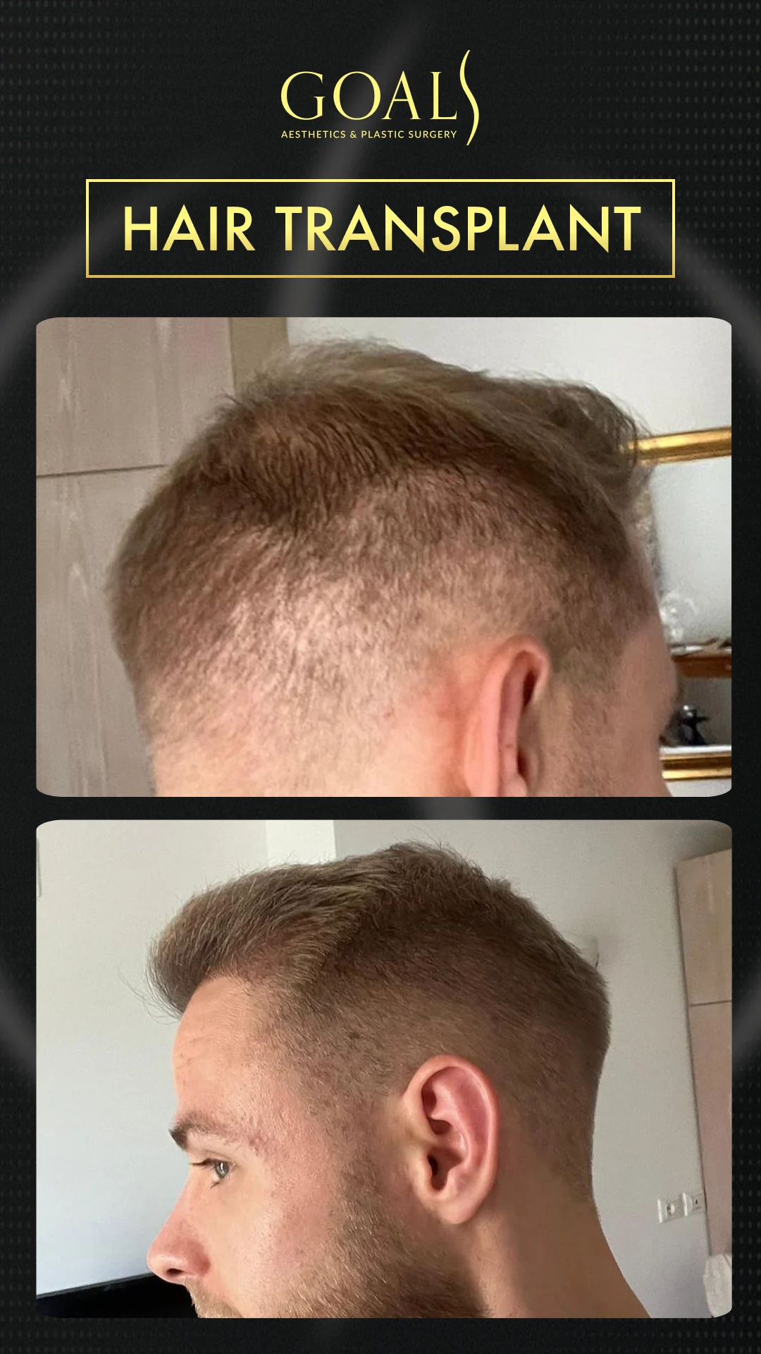 Before and after — Trasplante Capilar FUT, patient 4