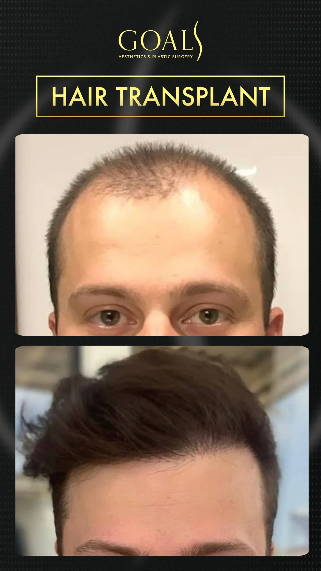 Before and after — Trasplante Capilar para Hombres, patient 1
