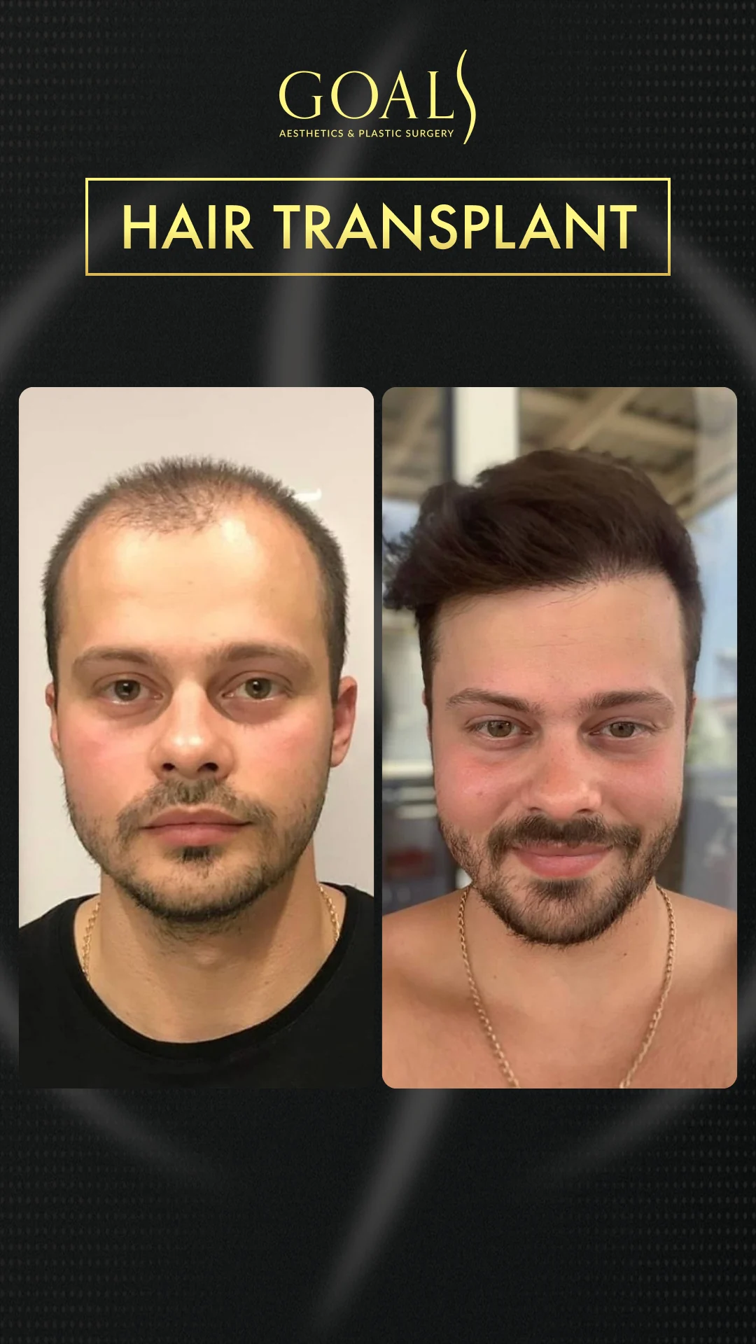 Before and after — Trasplante Capilar para Hombres, patient 2