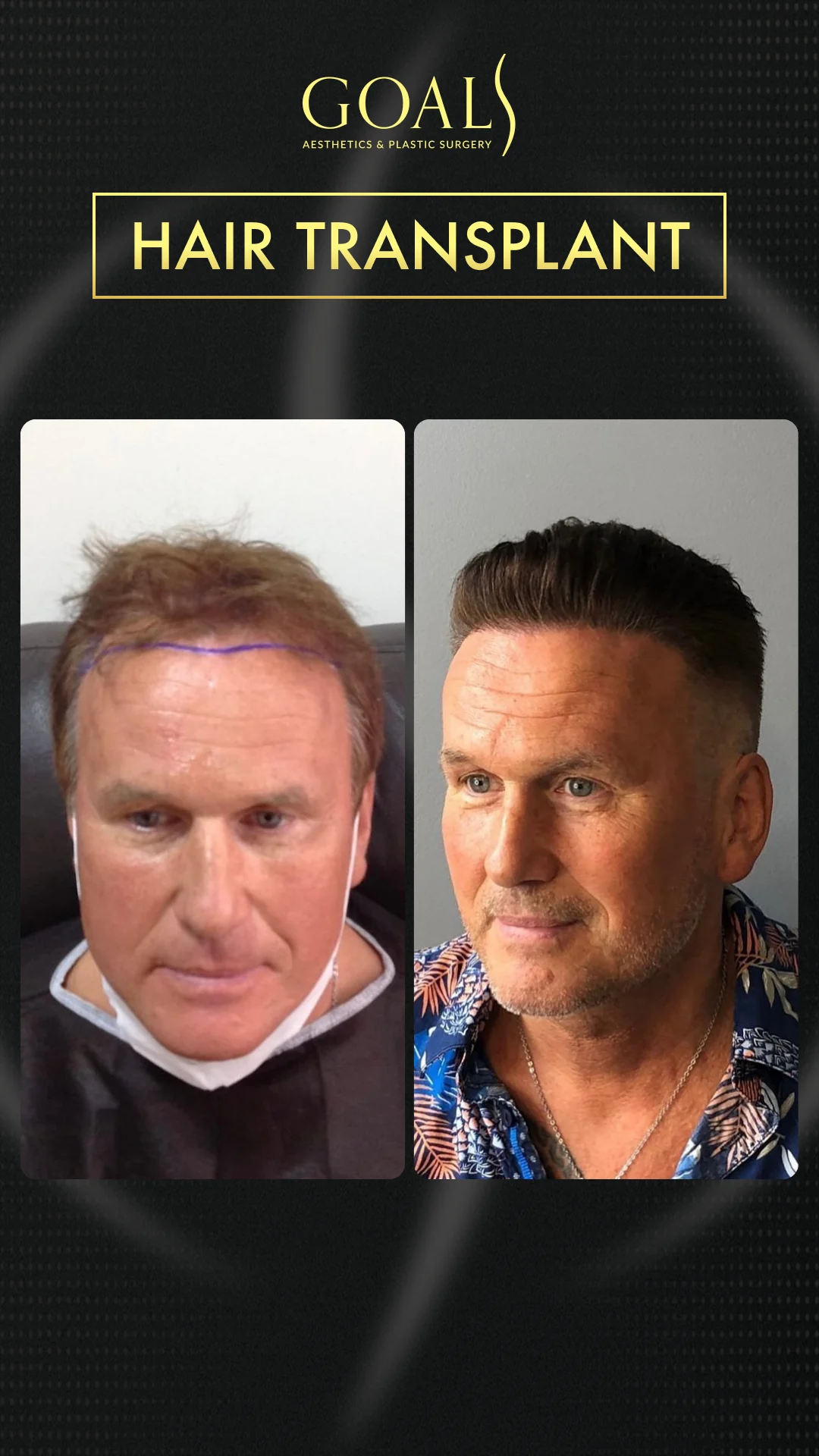 Before and after — Trasplante Capilar para Hombres, patient 3