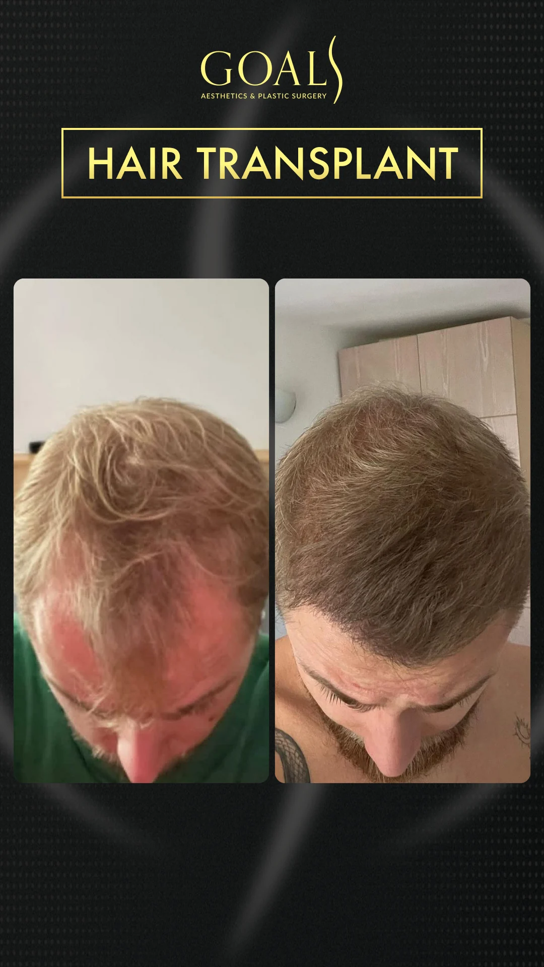 Before and after — Trasplante Capilar FUT, patient 5