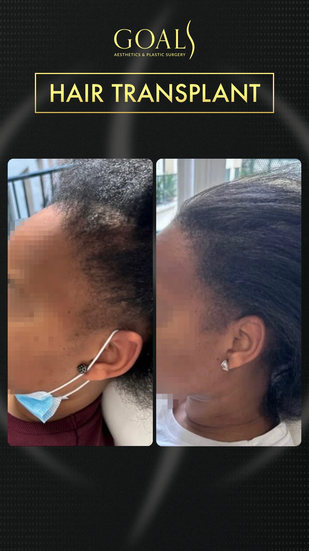 Before and after — Afro Hair Transplant · Atlanta Walton St., patient 2