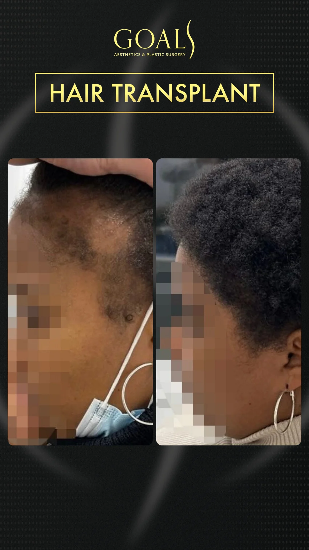 Before and after — Afro Hair Transplant · Atlanta Walton St., patient 3