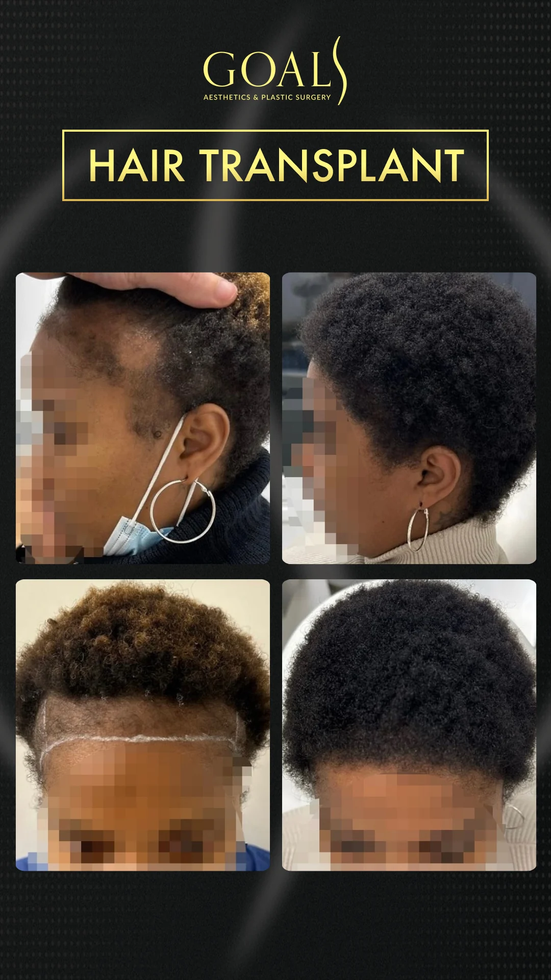 Before and after — Afro Hair Transplant · Atlanta Walton St., patient 4