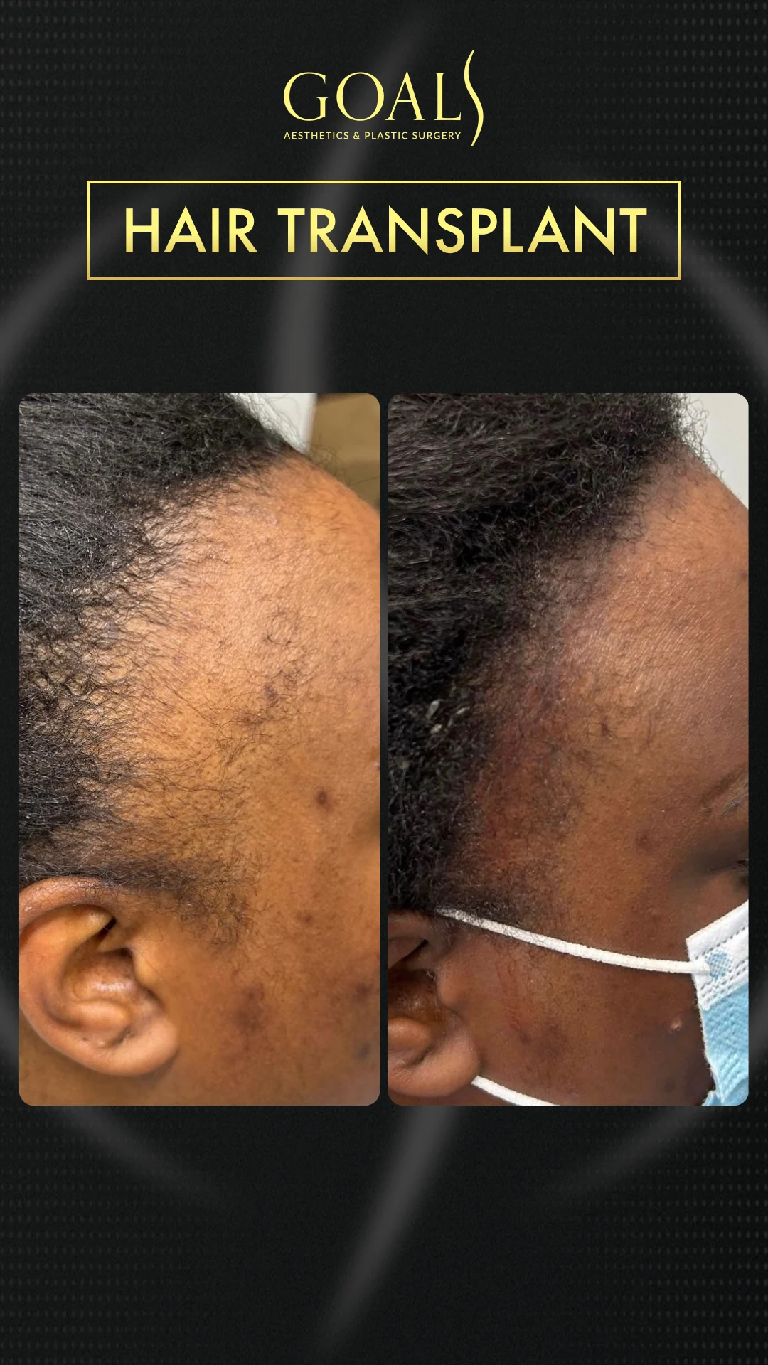 Before and after — Afro Hair Transplant · Atlanta Walton St., patient 5