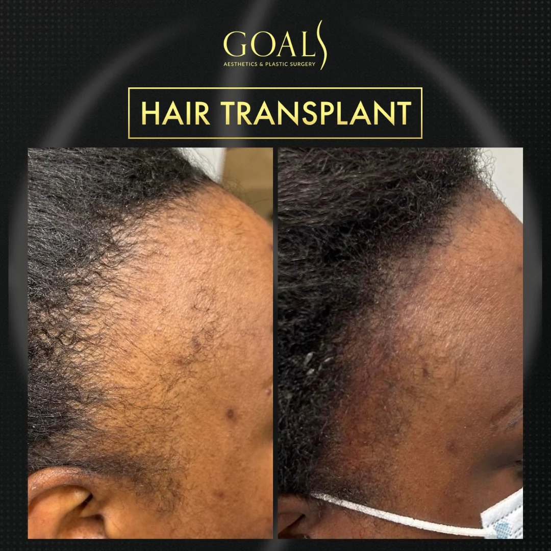 Before and after — Afro Hair Transplant, patient 1