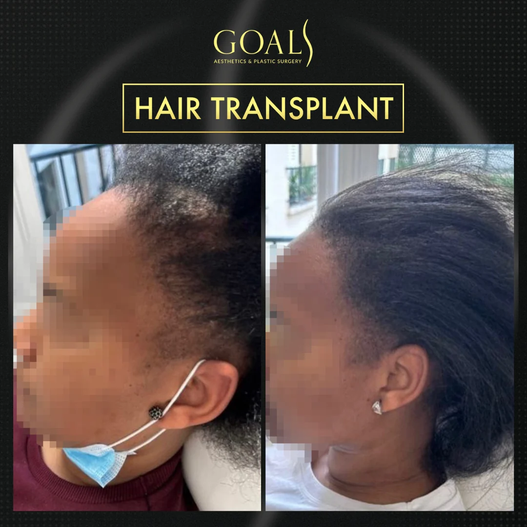 Before and after — Afro Hair Transplant, patient 2