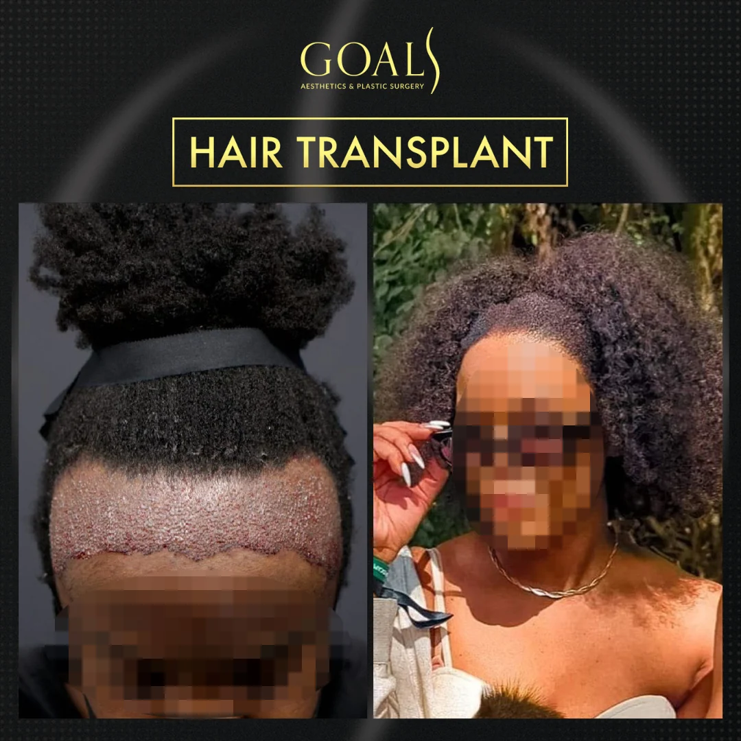 Before and after — Afro Hair Transplant, patient 3