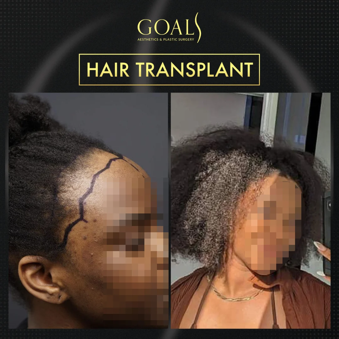 Before and after — Afro Hair Transplant, patient 4