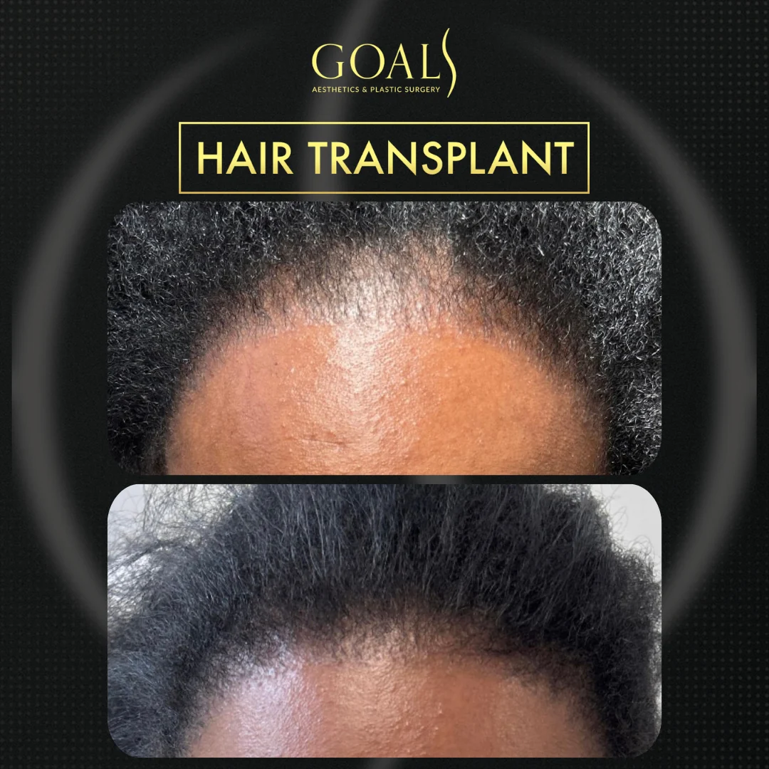 Before and after — Afro Hair Transplant, patient 5
