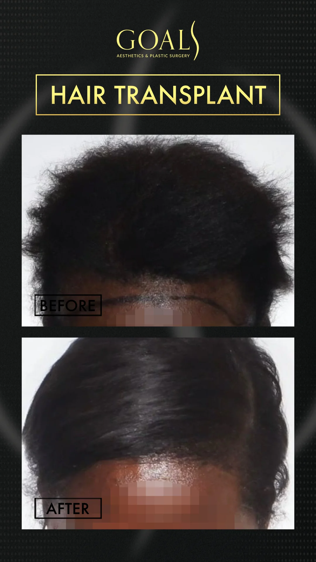 Before and after — Afro Hair Transplant, patient 6