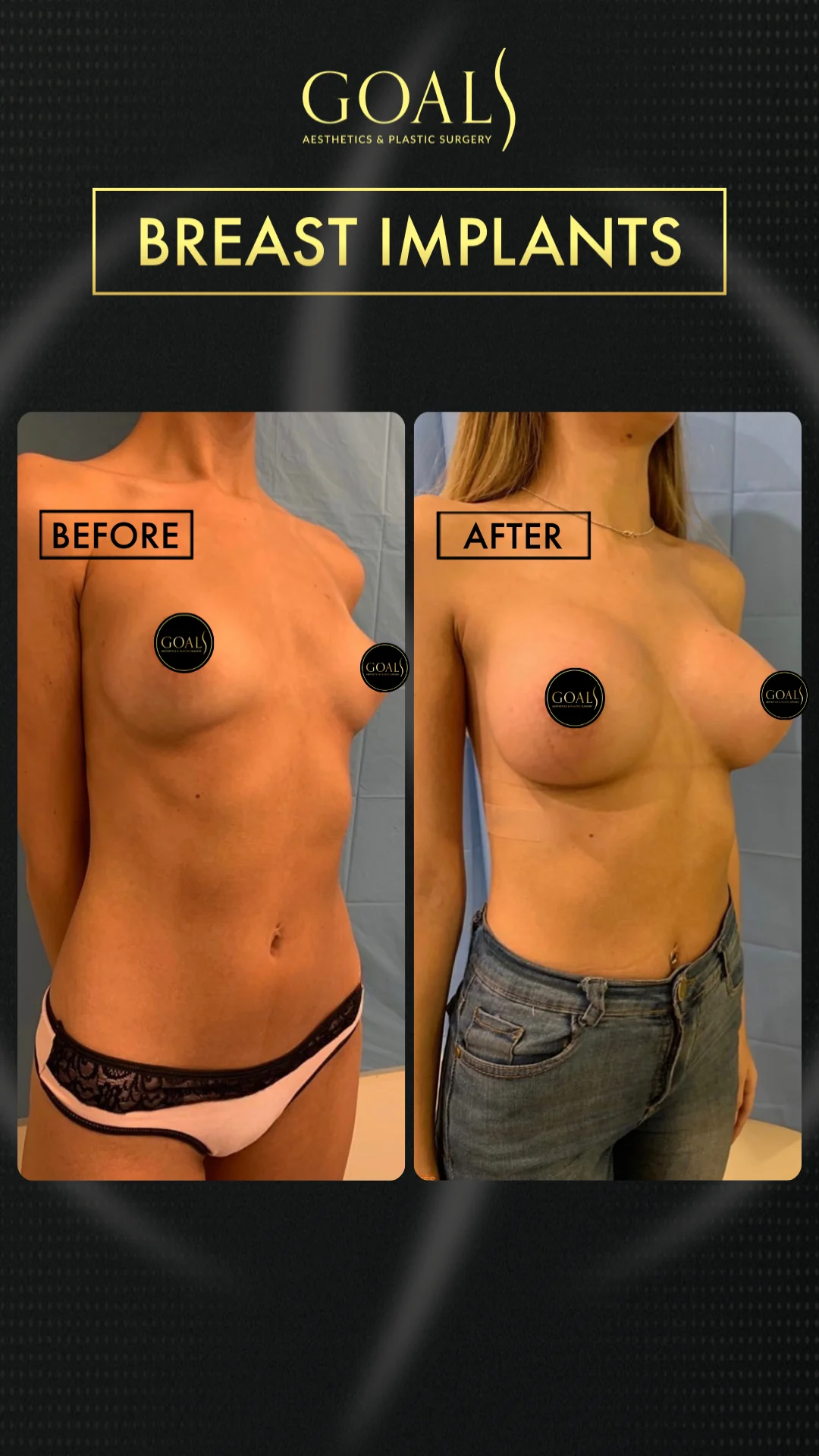 Before and after — Breast Augmentation, patient 3