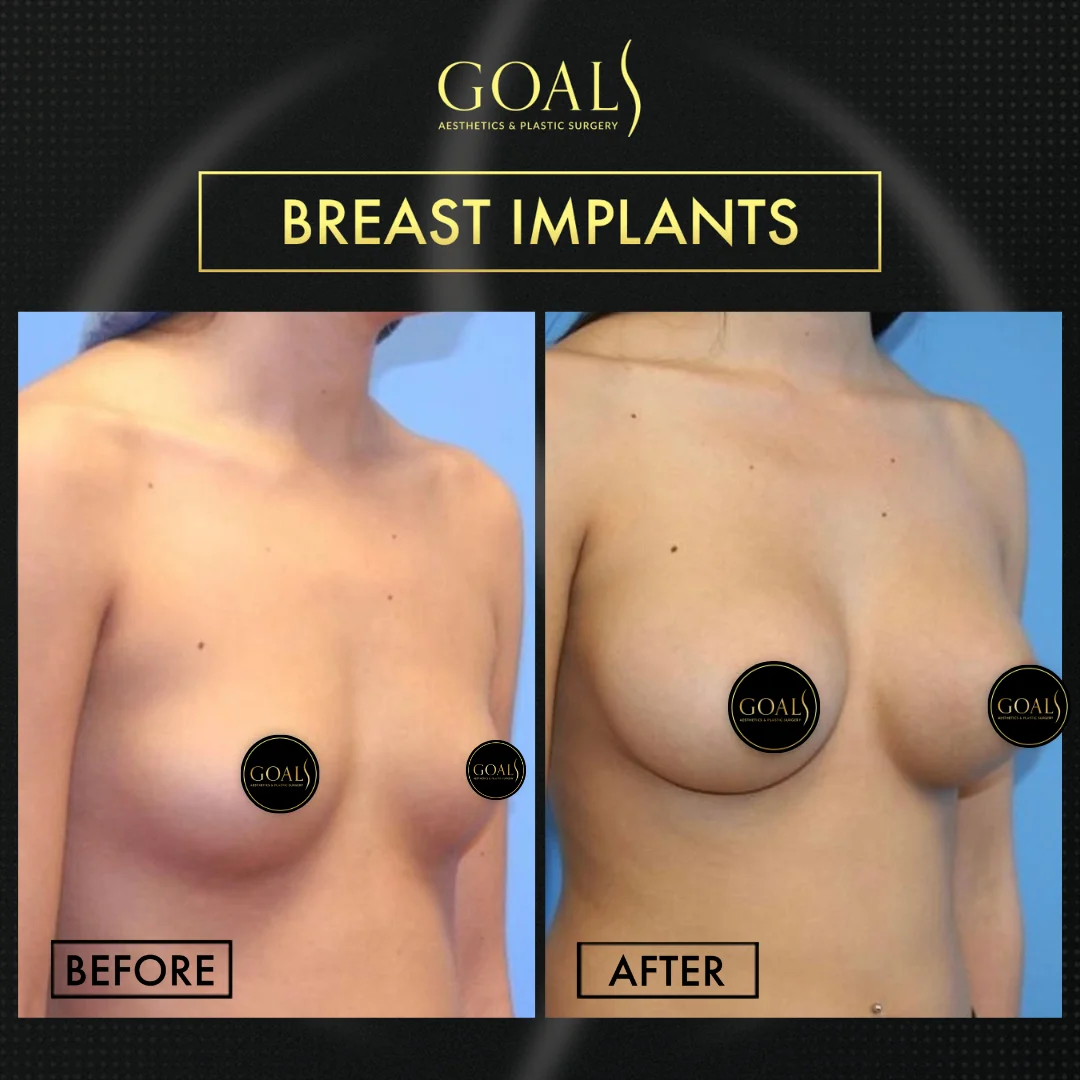 Before and after — Breast Augmentation, patient 4