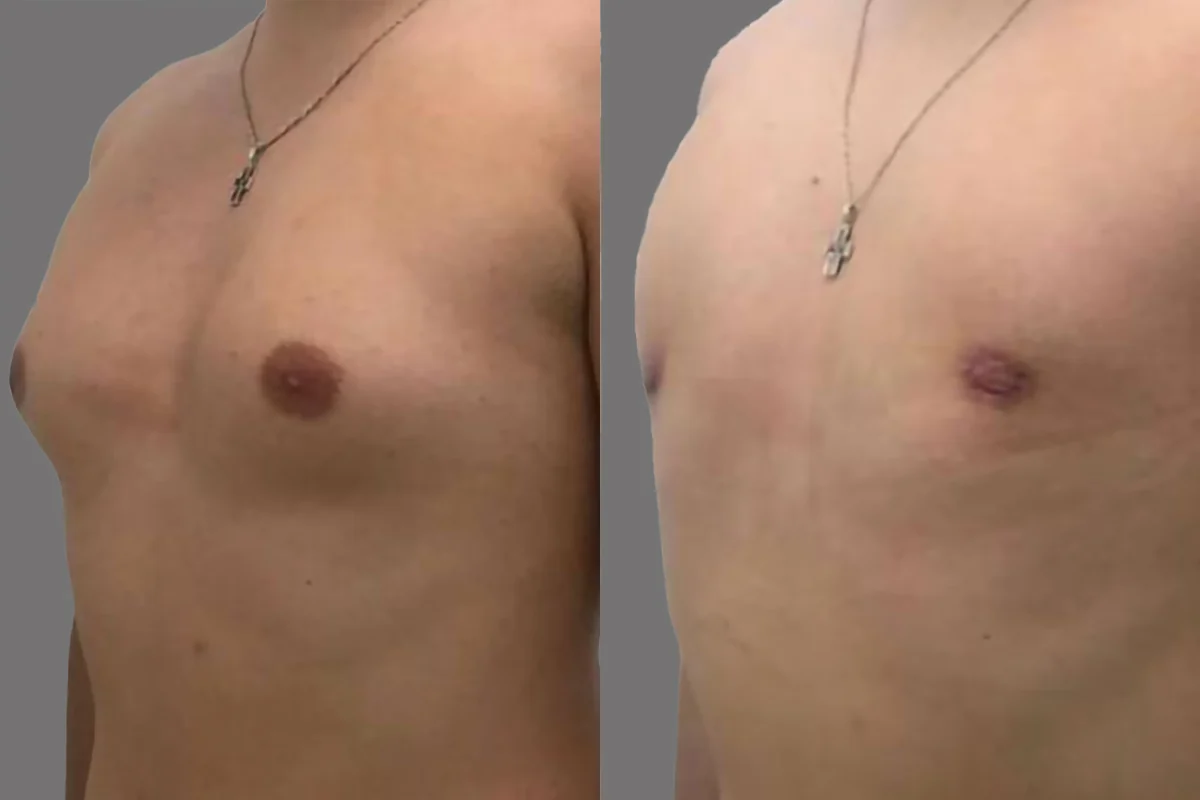 Before and after — Cirugía de Ginecomastia, patient 2