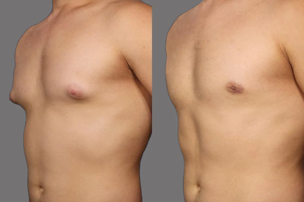 Before and after — Cirugía de Ginecomastia, patient 3