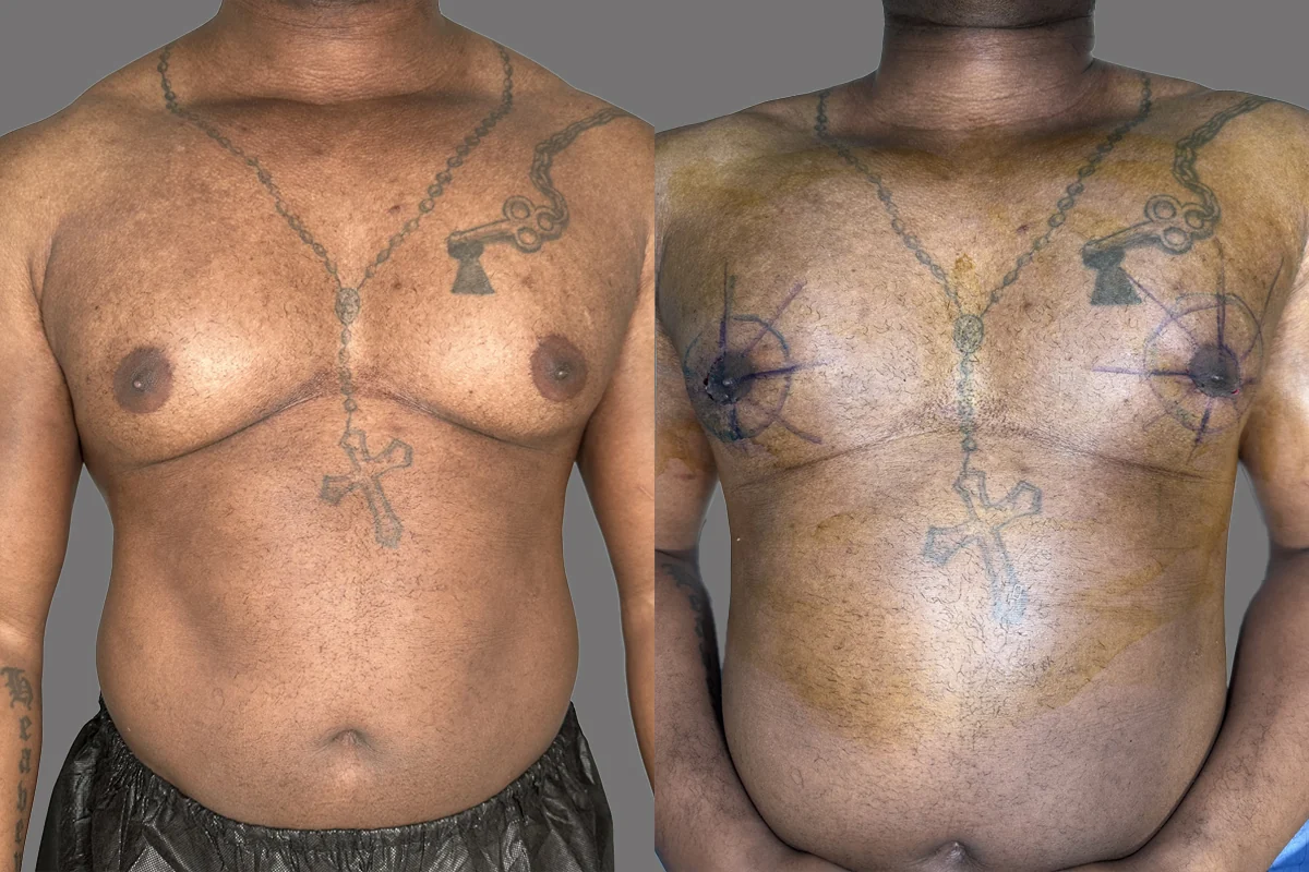 Before and after — Cirugía de Ginecomastia, patient 4