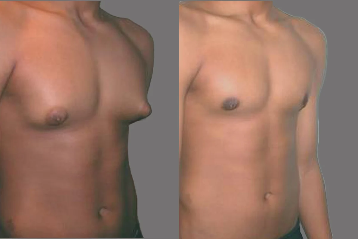 Before and after — Cirugía de Ginecomastia, patient 1