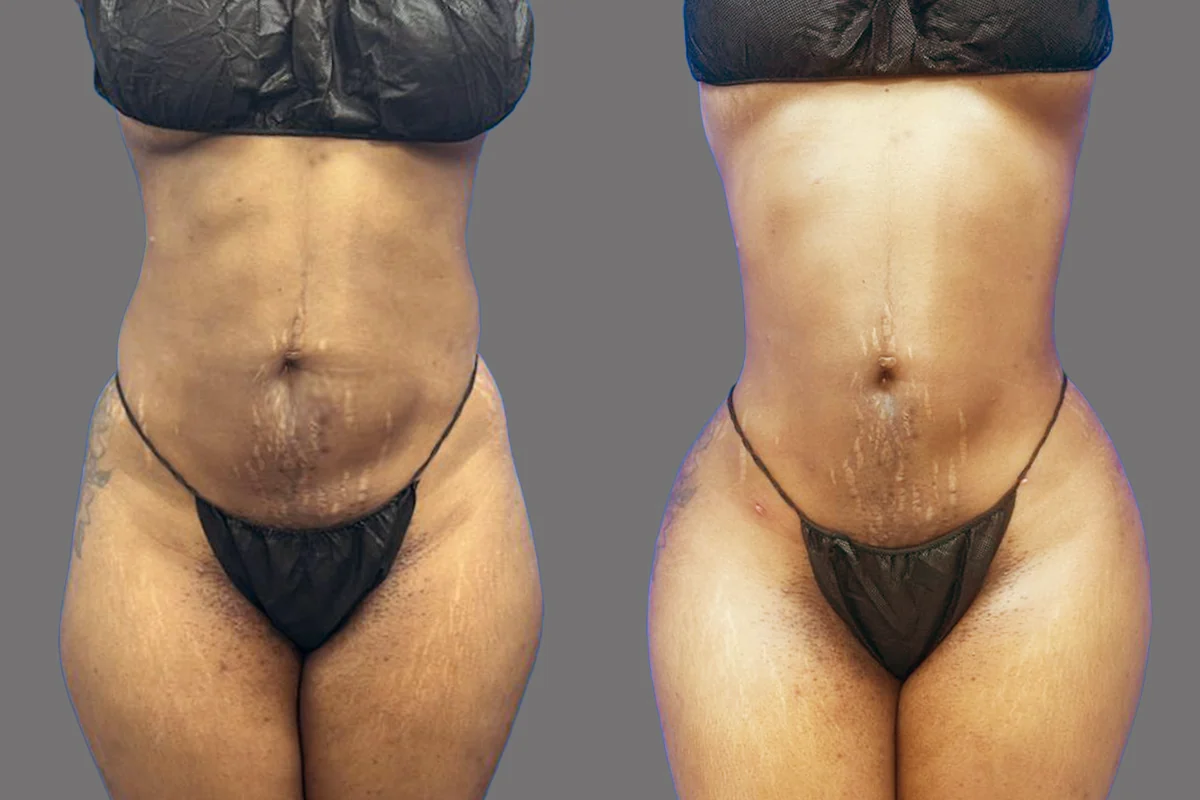 Before and after — J-Plasma para Tensar la Piel, patient 2