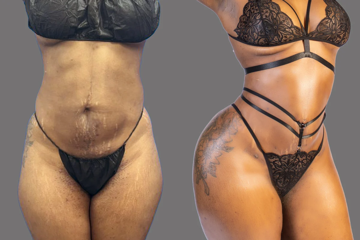 Before and after — J-Plasma para Tensar la Piel, patient 3