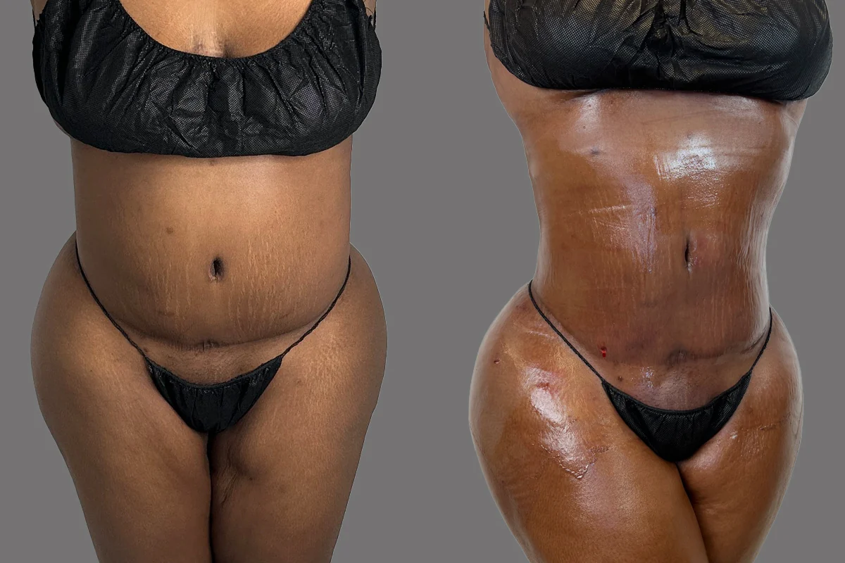 Before and after — J-Plasma para Tensar la Piel, patient 4