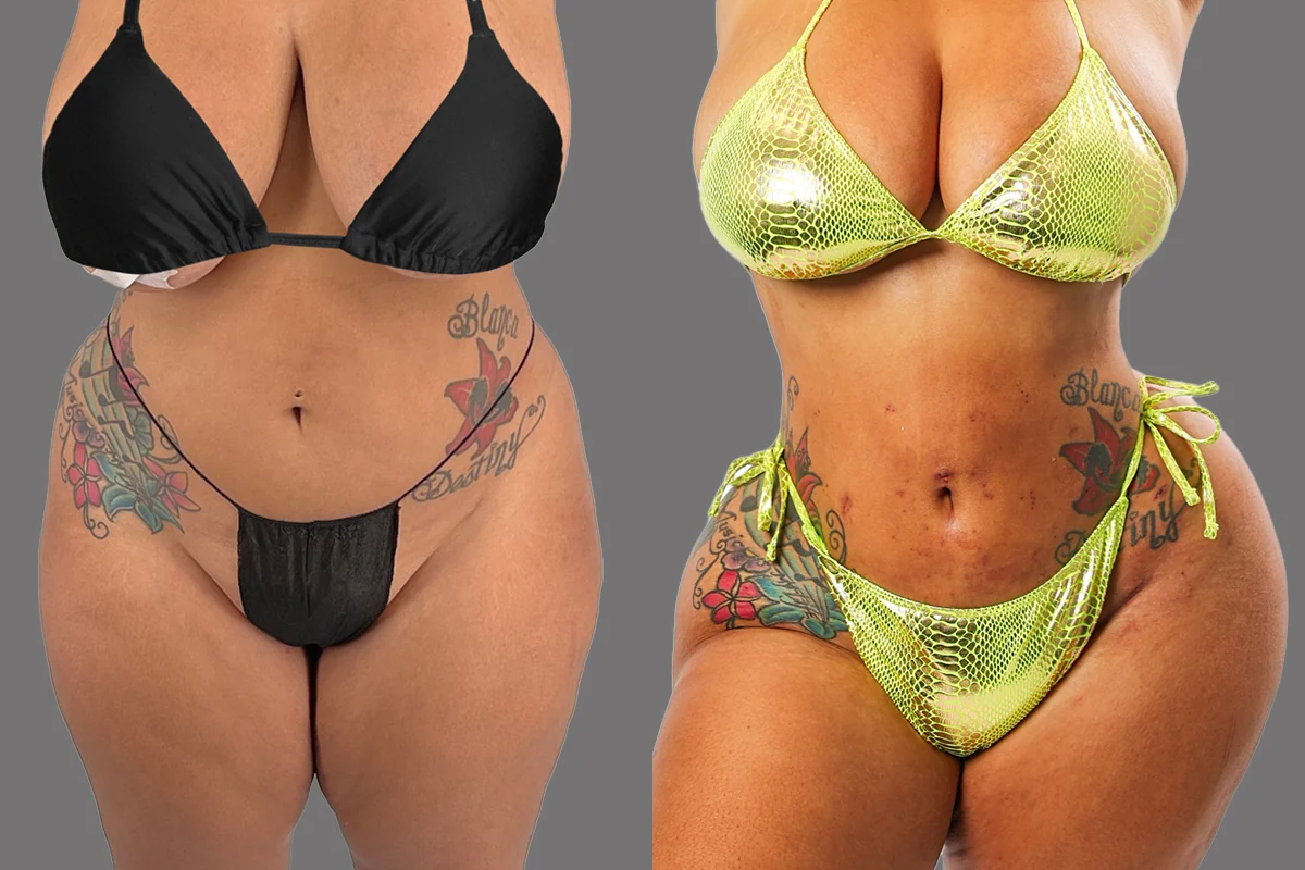 Before and after — J-Plasma para Tensar la Piel, patient 5