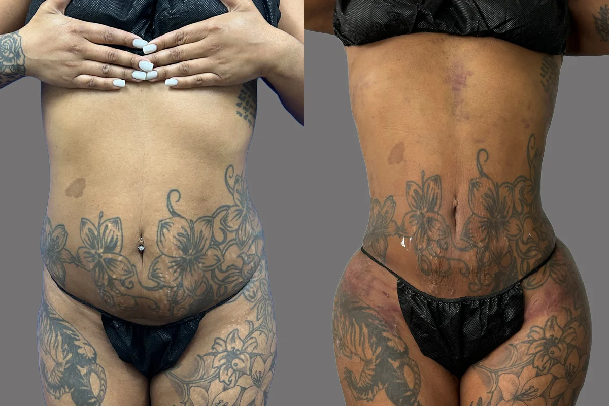 Before and after — J-Plasma para Tensar la Piel, patient 6