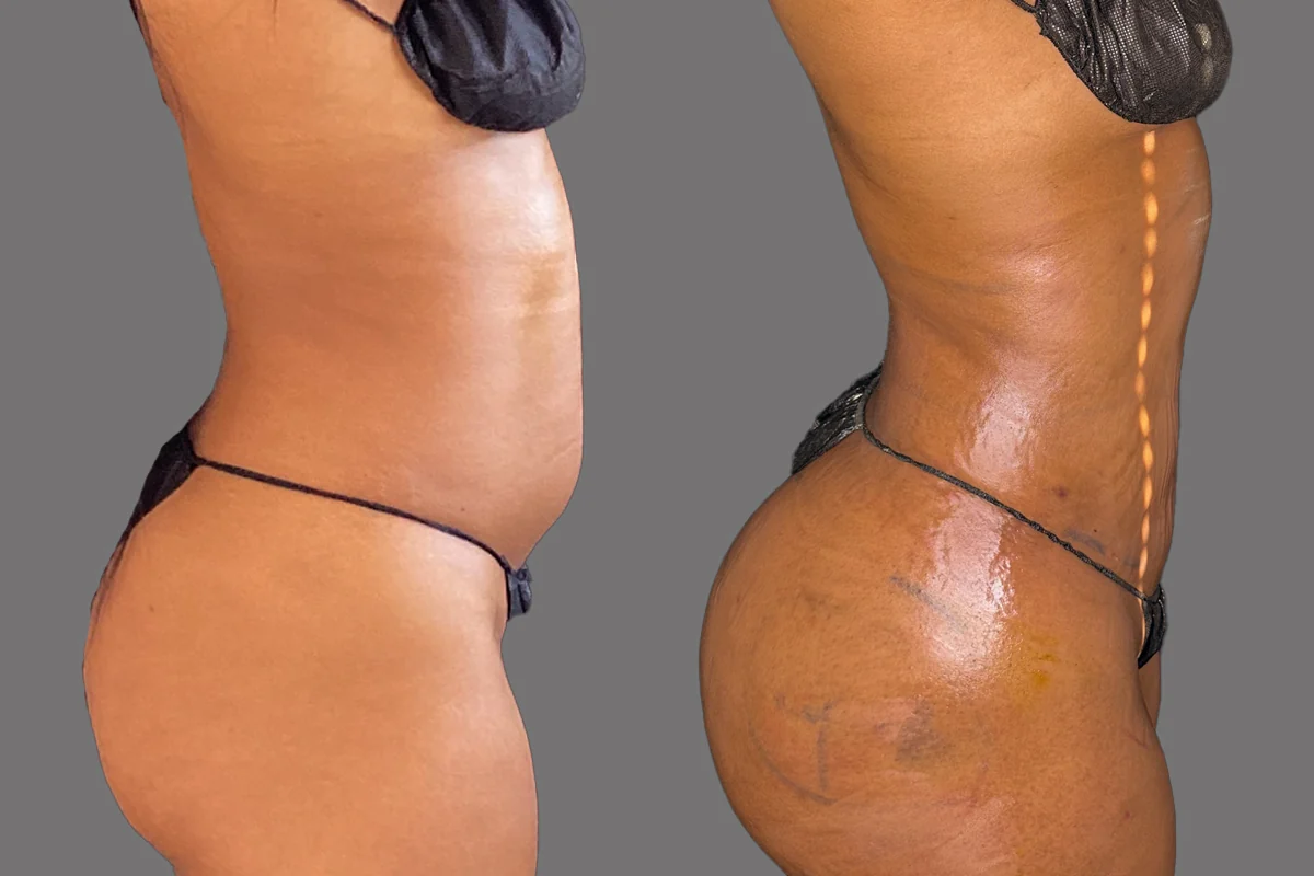 Before and after — J-Plasma Skin Tightening · Atlanta Tucker Rd., patient 2