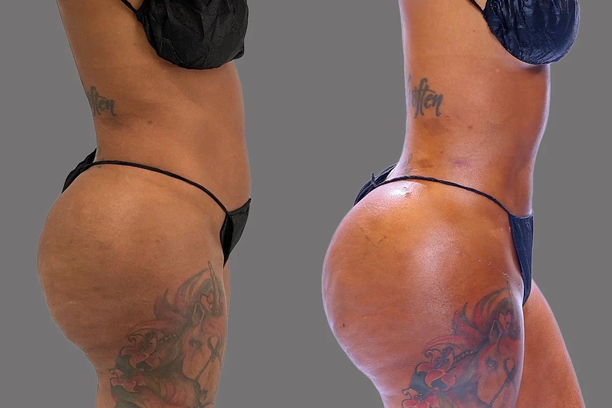 Before and after — J-Plasma Skin Tightening · Atlanta Tucker Rd., patient 3