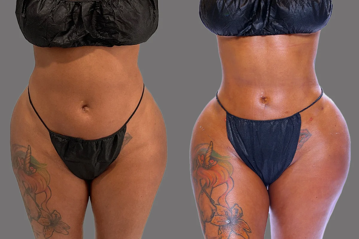 Before and after — J-Plasma Skin Tightening, patient 1