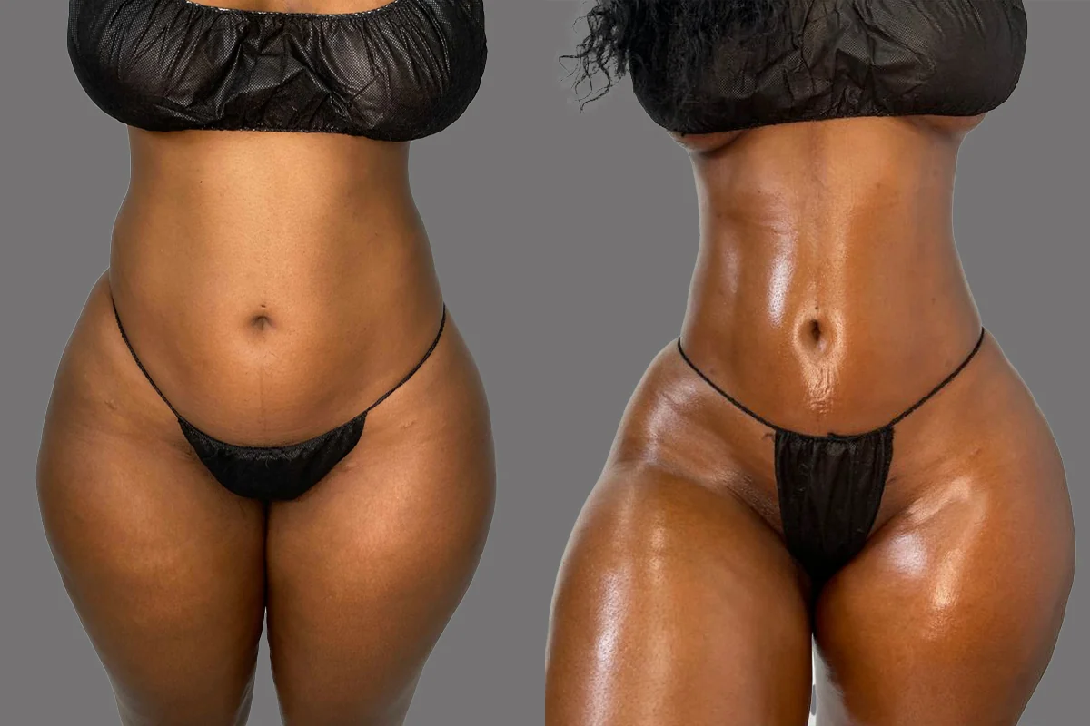 Before and after — J-Plasma Skin Tightening · Gaithersburg, patient 1